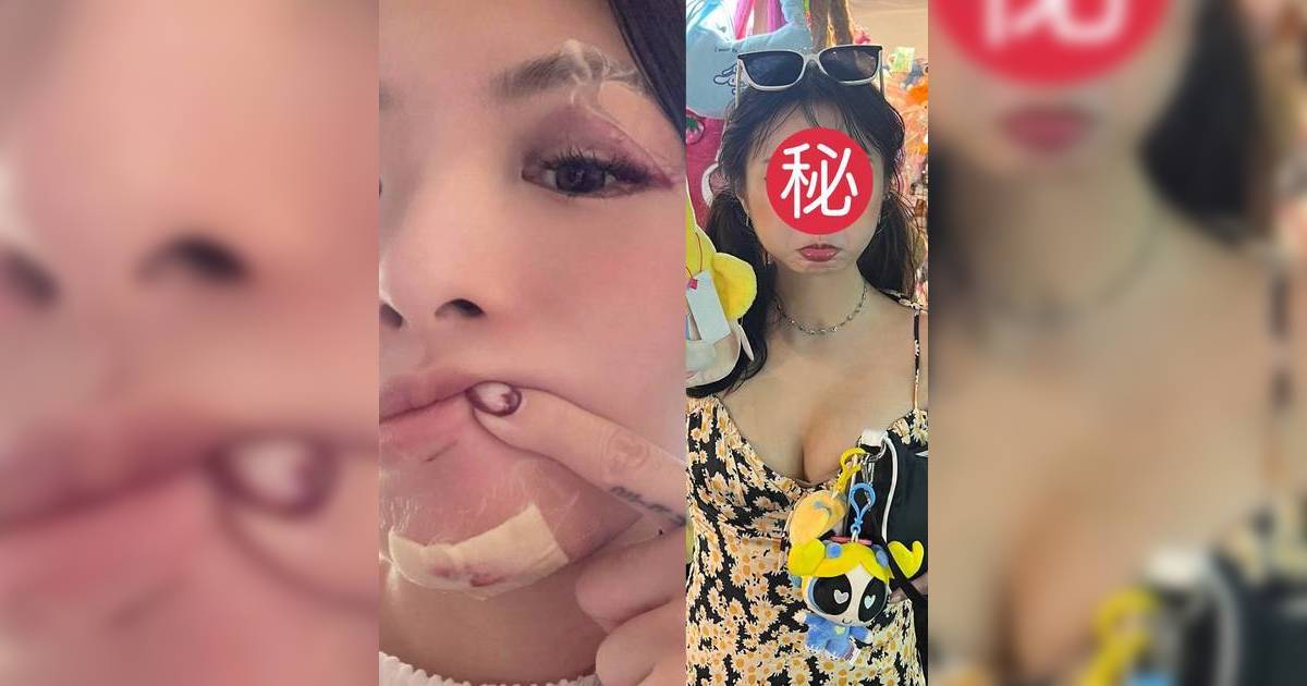 「翻版陳法拉」恐怖毀容照曝光 面骨折斷傷勢駭人疑遭家暴