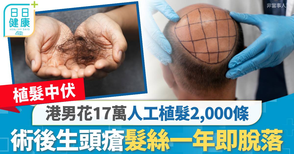 植髮｜港男花17萬人工植髮2,000條　術後生頭瘡一年髮絲幾近全脫落