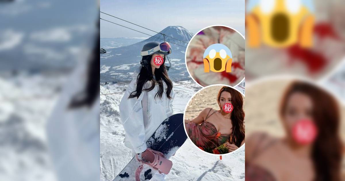 TVB小花日本出意外險毀容！後腦撞石標血陷昏迷 血染紙巾畫面嚇壞網民