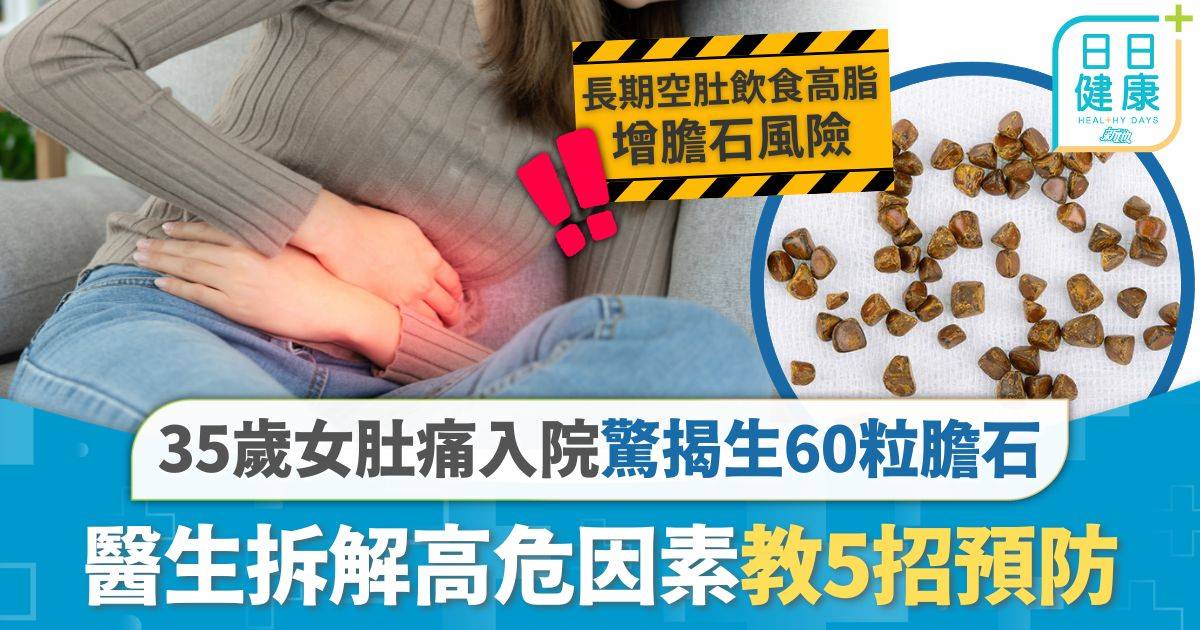 膽石｜35歲女長期不食早餐 肚痛入院驚揭生60粒膽石 醫生拆解高危因素教5招預防
