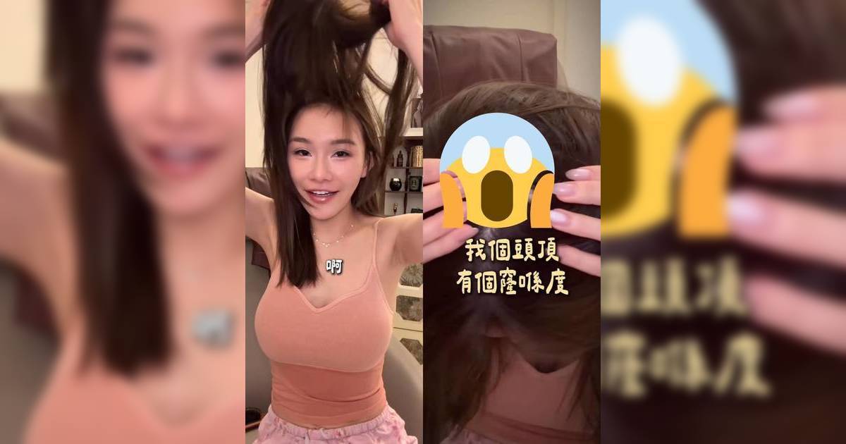 五索拍片自爆變樣真相 親自掀開假髮「鬼剃頭」情況大方任睇