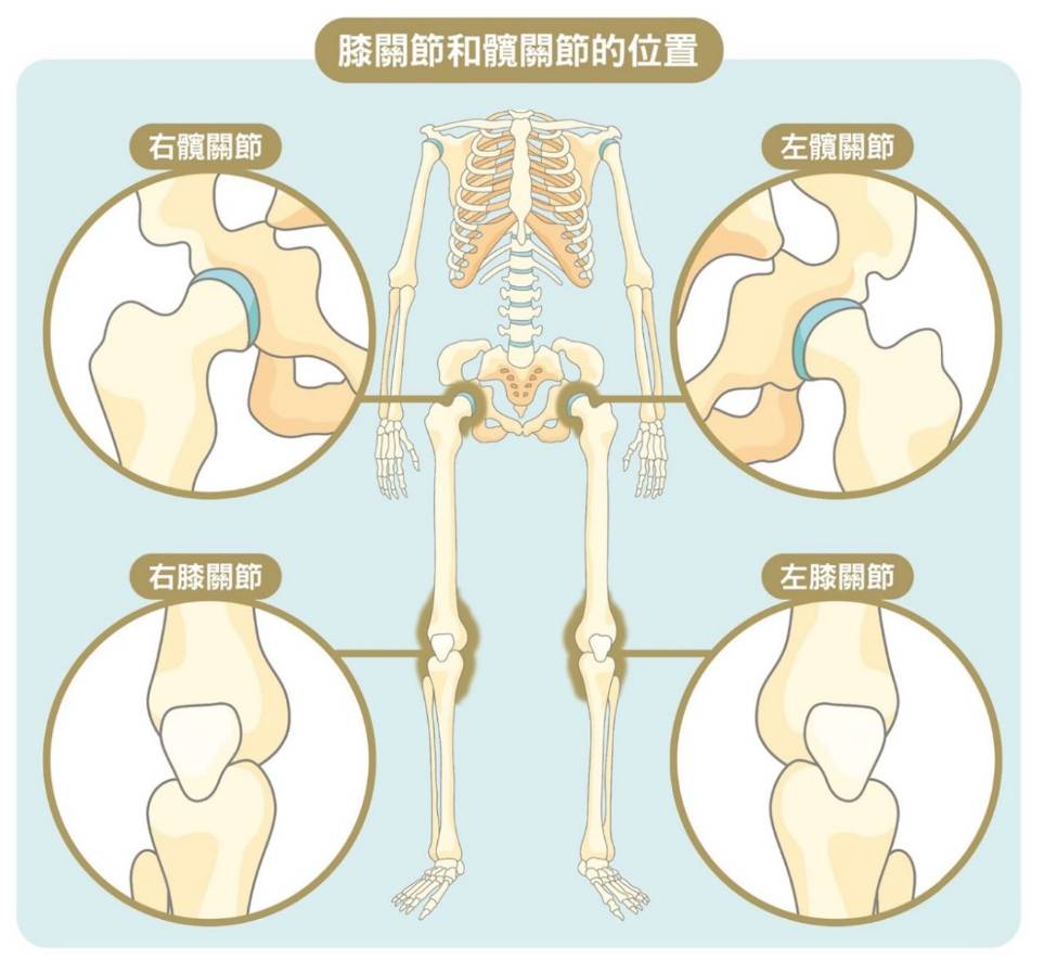 換骹手術費用 全關節置 關節炎種類繁多,包括骨關節炎(退化性關節炎)、類風濕性關節炎、創傷後關節炎及骨頭缺血性壞死。(圖片來源:消委會)