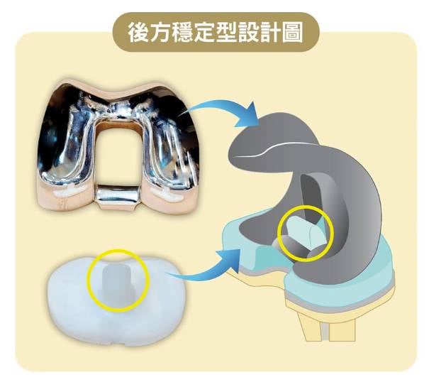 換骹手術費用 全關節置 後方穩定型的繪圖。(圖片來源:消委會)