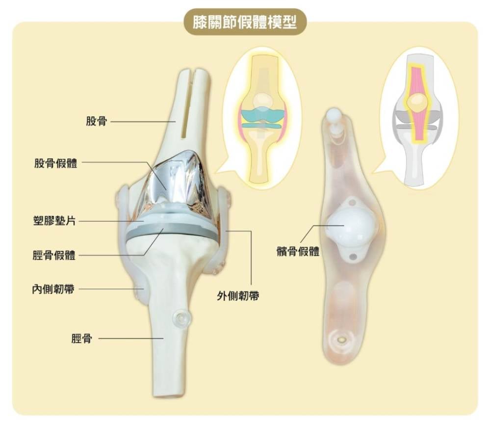 換骹手術費用 全關節置 植入到關節位置的假體(prosthesis),會因應固定的方式而選用不同的物料,與骨頭相接合的組件一般是以鈷鉻合金或鈦合金製成。(圖片來源:消委會)