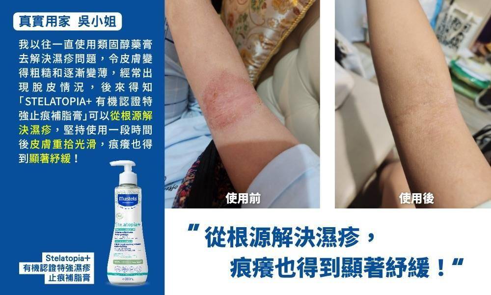 濕疹 (圖片來源:Mustela)