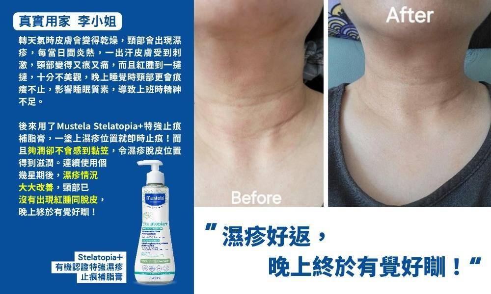 濕疹 (圖片來源:Mustela)