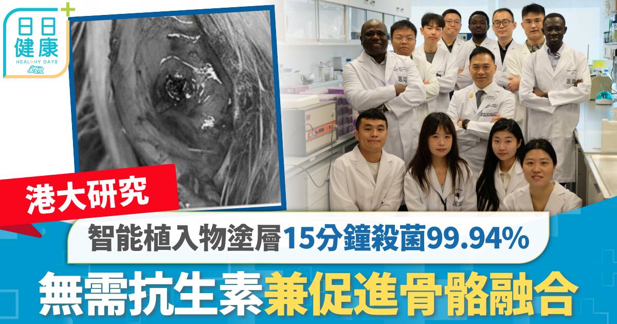 港大研究｜智能植入物塗層15分鐘殺菌99.94% 無需抗生素兼促進骨骼融合