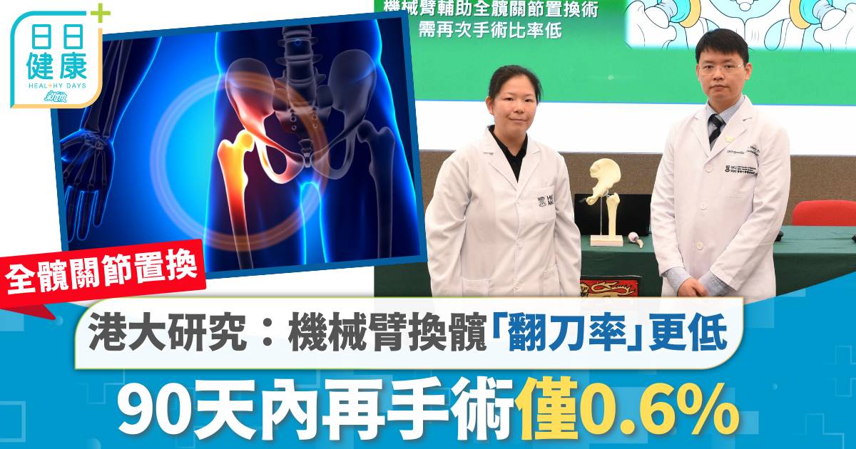 全髖關節置換｜港大研究：機械臂換髖「翻刀率」更低　90天內再手術僅0.6%