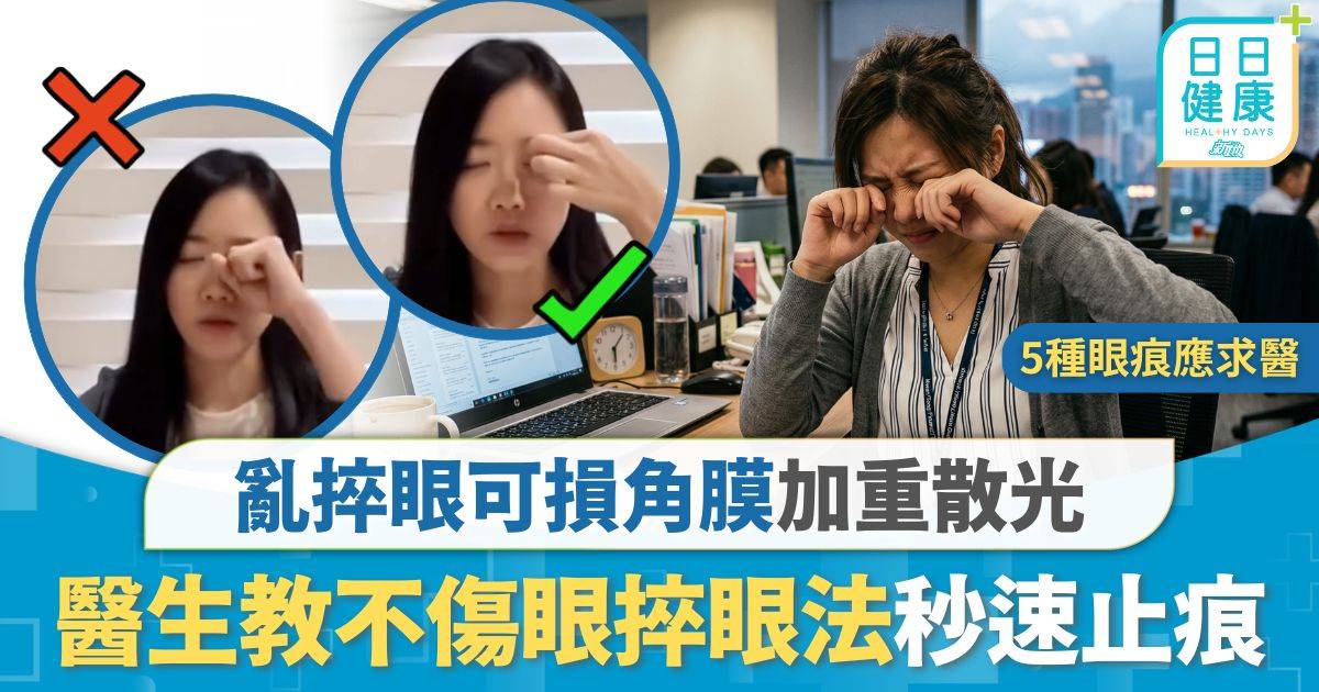眼部健康｜亂捽眼可損角膜加重散光 醫生教不傷眼捽眼法 有效止痕同時紓緩疲勞