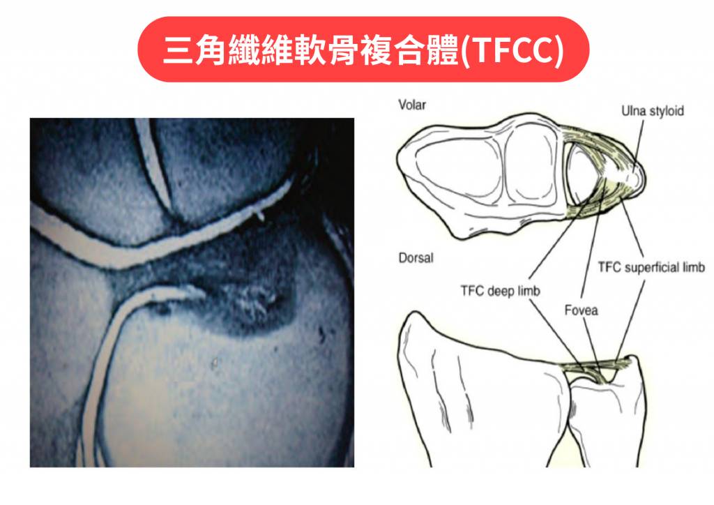圖一:三角纖維軟骨複合體(TFCC)(圖片來源:香港浸信會醫院提供)