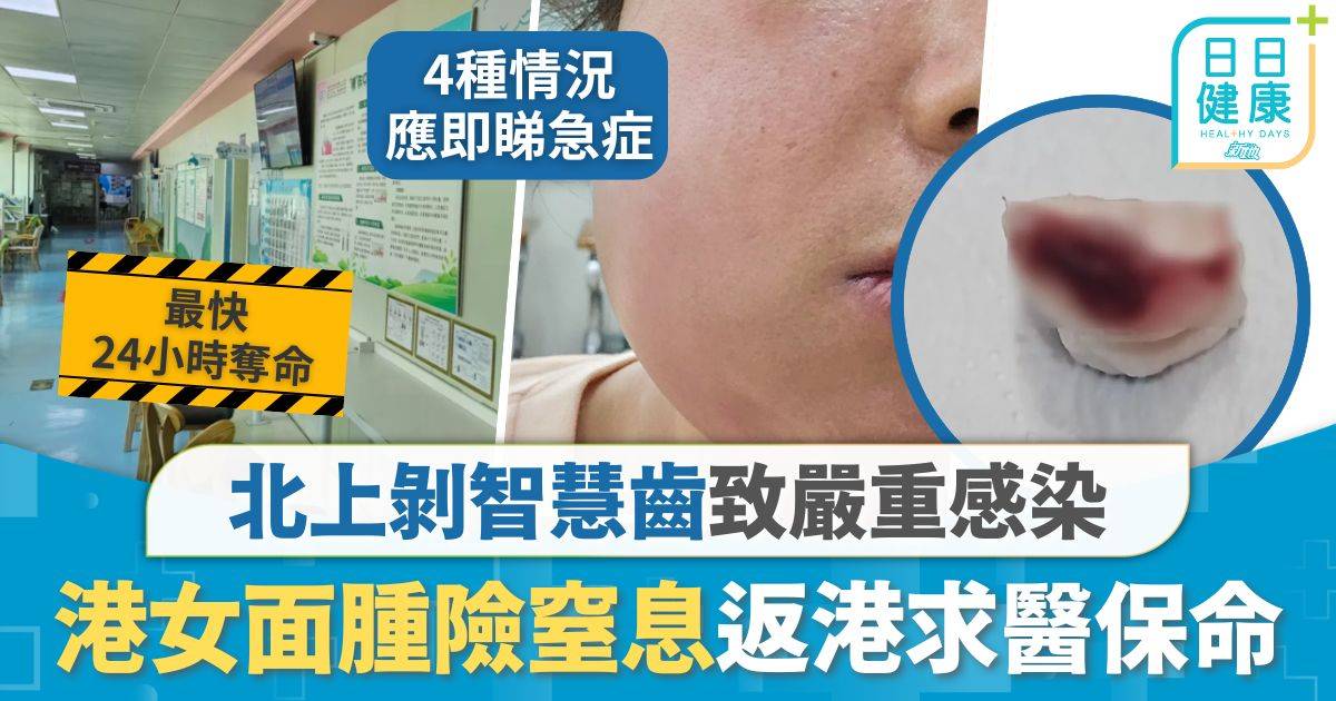 剝智慧齒｜北上剝智慧齒致嚴重感染 港女面腫成「豬頭」險窒息 漏夜返港睇急症保命