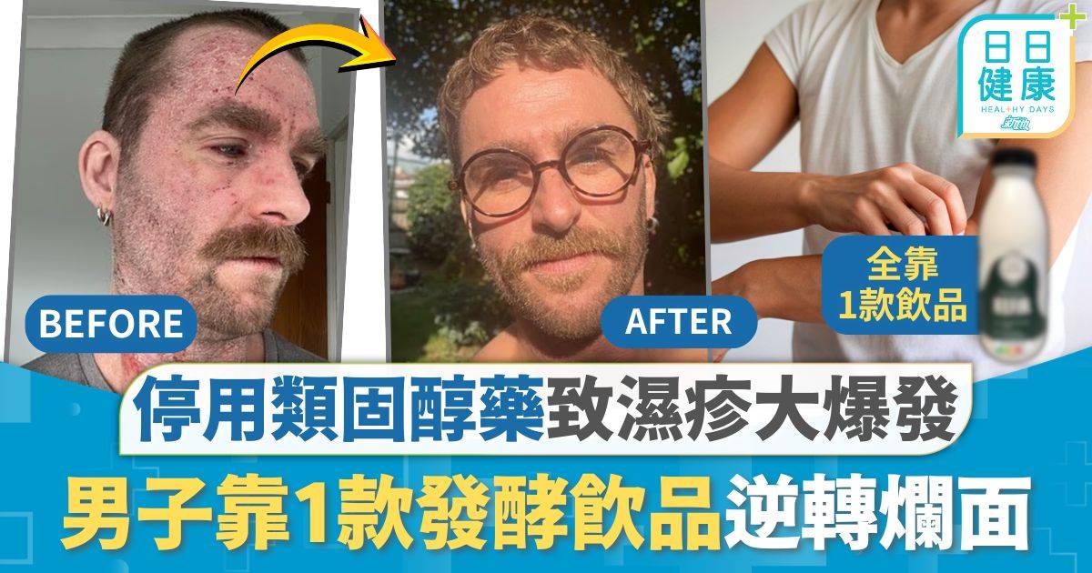 濕疹治療｜停用類固醇藥致濕疹大爆發 男子靠1款飲品逆轉爛面 皮膚脫胎換骨醫生拆解療效