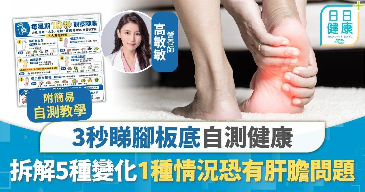 保健養生｜3秒睇腳板底自測健康 1種情況=肝膽代謝異常 專家拆解5種腳板變化