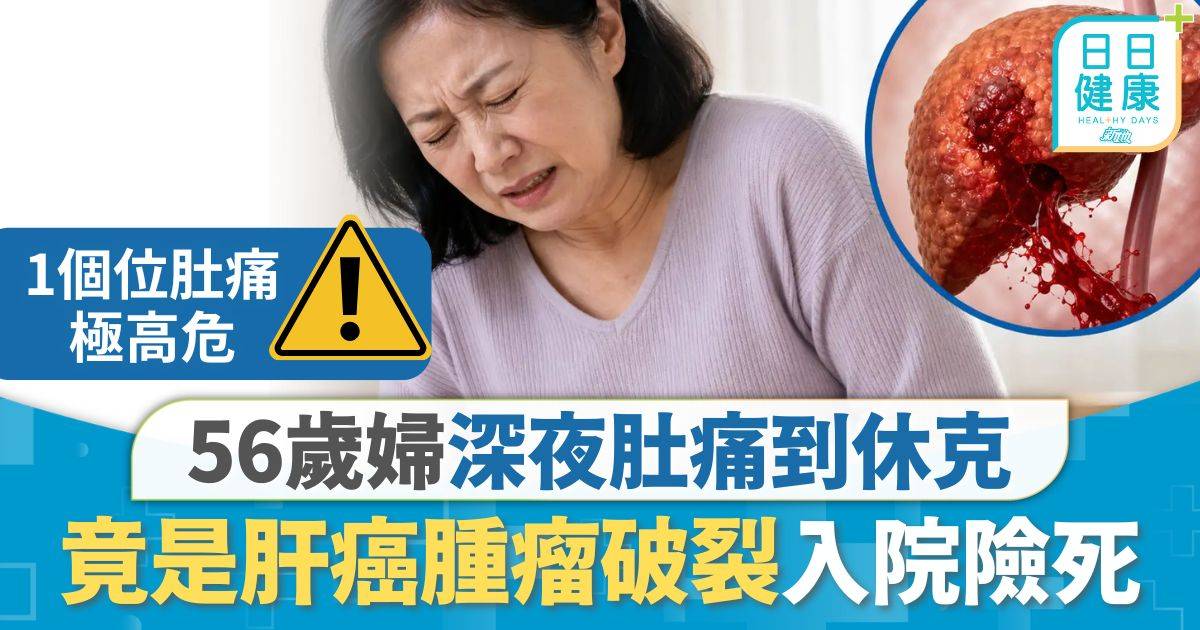 肝病｜56歲婦深夜肚痛到休克 竟是肝癌腫瘤破裂入院險死 肚痛伴隨5大特徵應即求醫