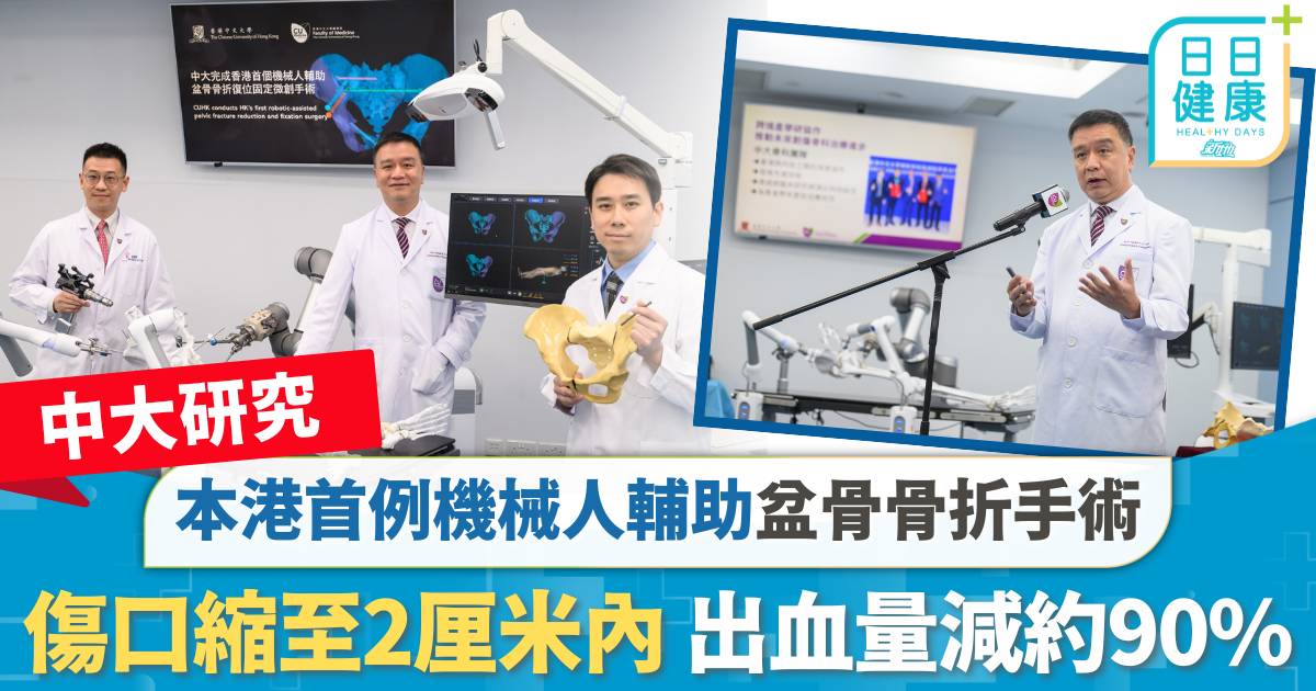 中大研究｜中大完成本港首例機械人輔助盆骨骨折手術 傷口縮至2厘米內、出血量減約90%