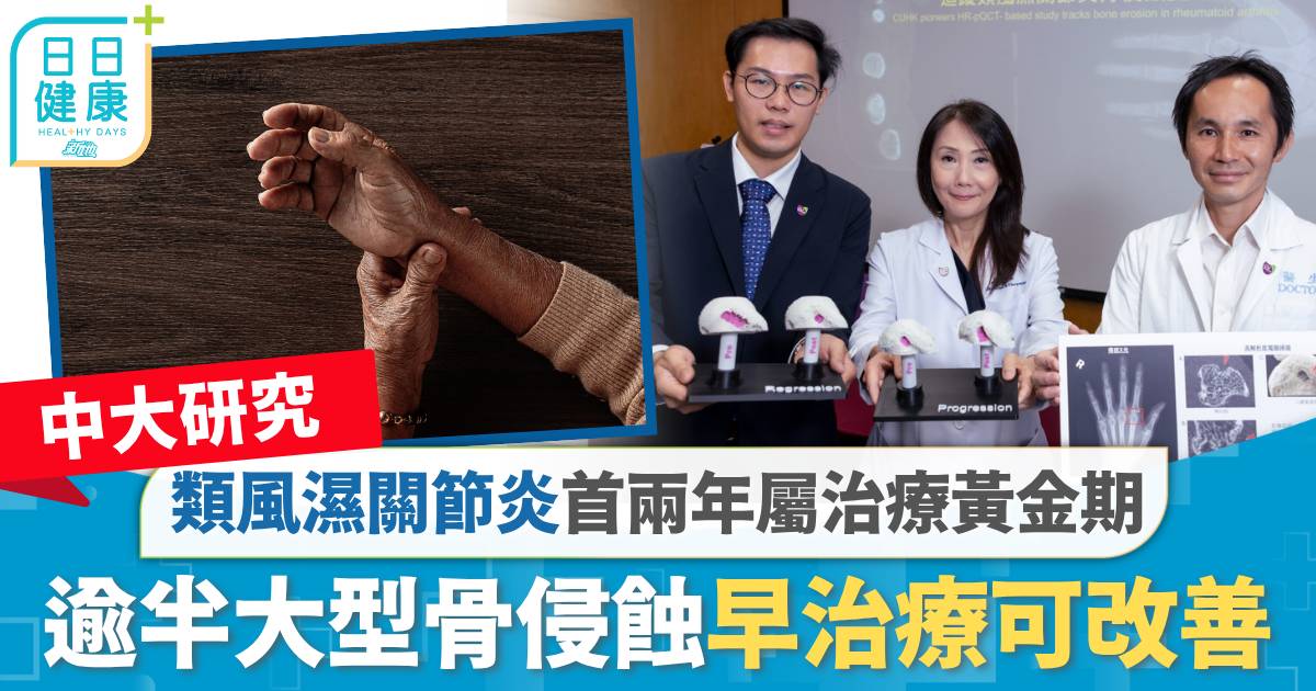 中大研究｜類風濕關節炎首兩年屬治療黃金期 逾半大型骨侵蝕早治療可改善