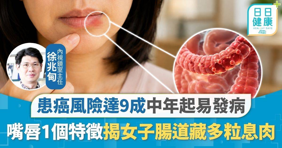 癌症病徵｜醫生憑嘴唇1個特徵 揭女子腸道藏多粒息肉 患癌風險達9成中年起易發病