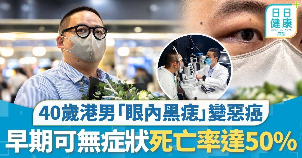 重症預防｜40歲港男「眼內黑痣」變惡癌 赴台做質子治療幸保視力 早期可無症狀 死亡率達50%