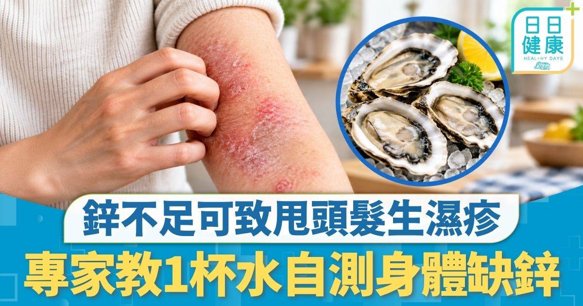 飲食營養｜鋅不足可致甩頭髮生濕疹 專家教1杯水自測身體缺鋅 推薦3種天然「補鋅」食物