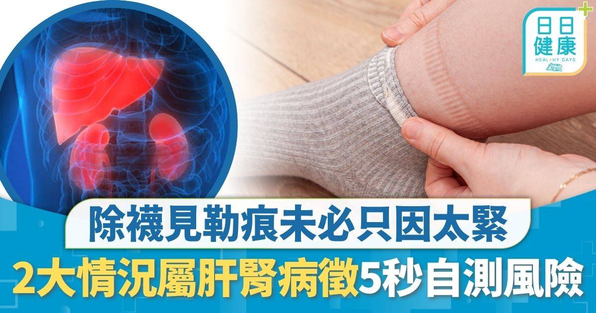 重症預防｜除襪見勒痕未必只因太緊 2大情況屬肝腎病徵 專家教5秒動作自測風險